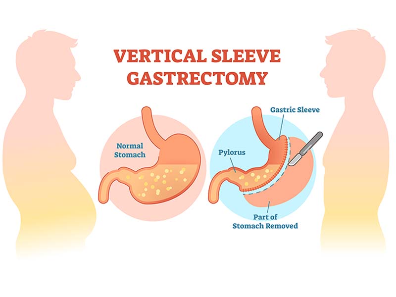 Gastric Sleeve Surgery