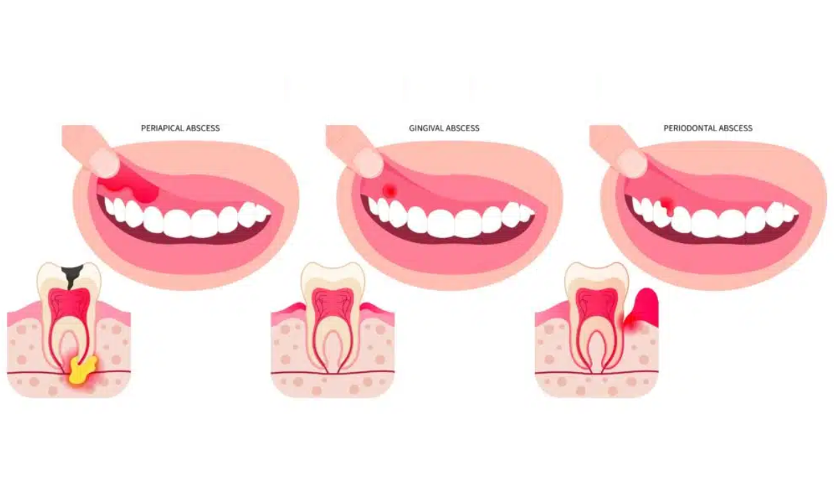 how long until a tooth infection kills you